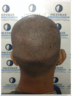 After-DHI-Direct-Hair -Implantation-Hair-Transplant-in-Mumbai-Face-Value-Clinic